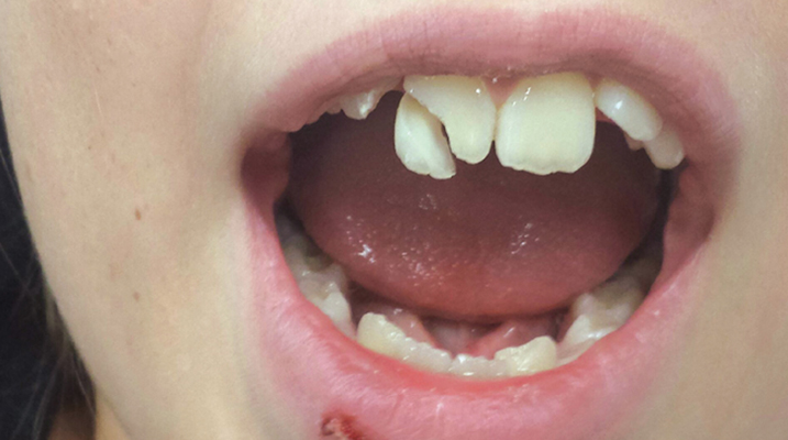 Guarding Your Grin: Understanding Traumatic Tooth Injuries in Sports
